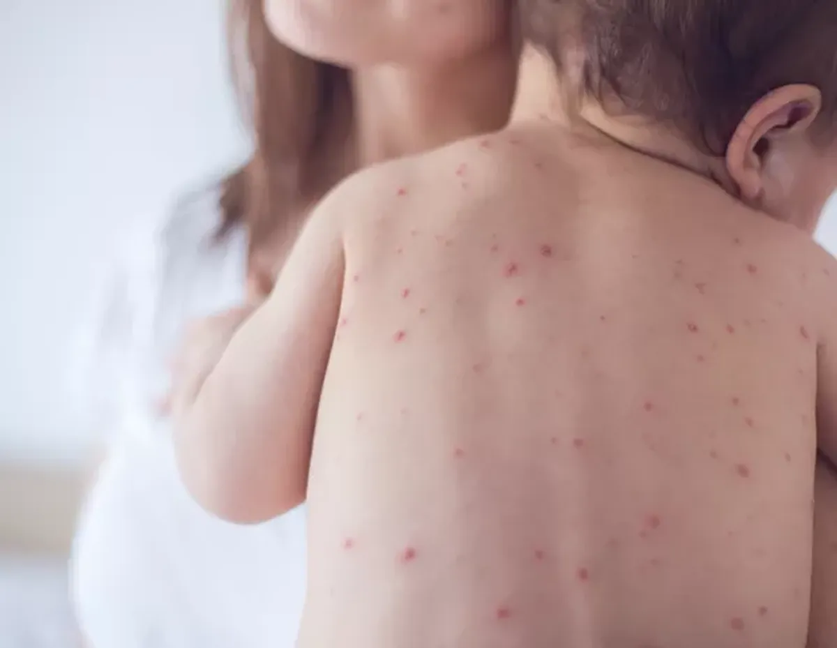 São Paulo Confirma Aumento de Casos de Sarampo e Intensifica Campanha de Vacinação